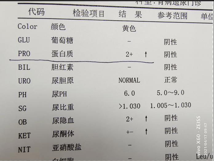 孩子出现尿蛋白跟喝水少有关系吗?