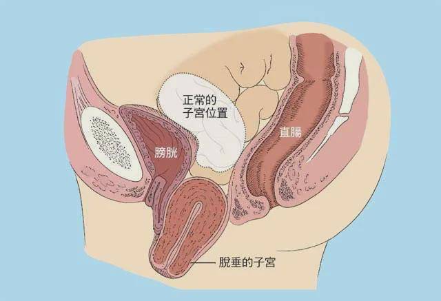 阴道前后壁又与膀胱,直肠相邻,因此子宫脱垂还可同时伴有膀胱尿道和