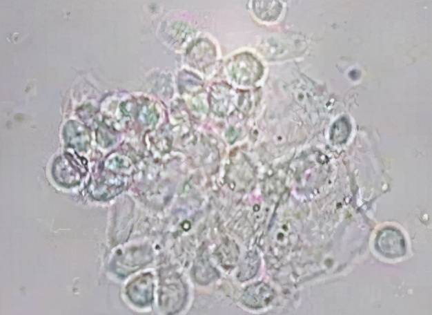 上图显微镜下可见念珠菌及菌丝 上图显微镜下可见滴虫 温馨提示: 1.