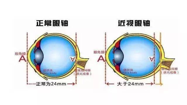 近视也就无法被治愈,只能采取一定手段(验配眼镜,近视手术)改变平行