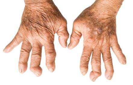 如何早期发现类风湿性关节炎可以通过这七种手指关节变化