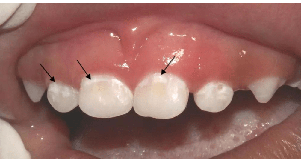 聊聊宝宝牙齿脱矿这件事,早期牙齿脱矿是可控的!_牙釉质