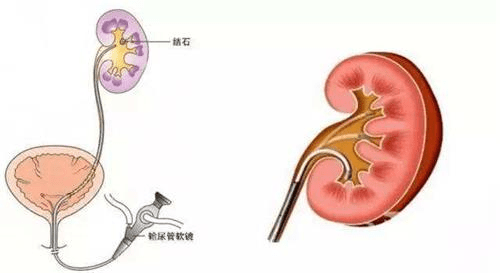 医治肾结石,云南结石病医院"保护肾脏"的纤维肾镜取石