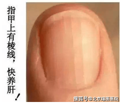 【健康】肝脏好不好,看看手有没有这四个症状?_指甲