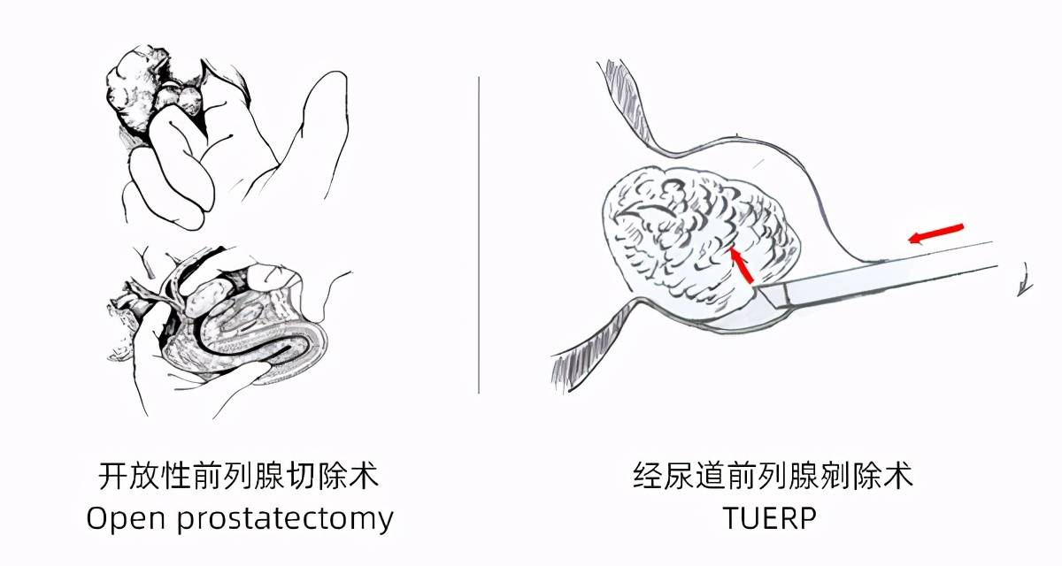 手术表演和学术讲座"经尿道前列腺剜除术"被外国专家称为"chinese