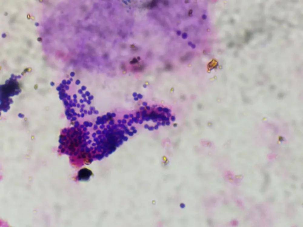 荧光显微镜从他的手上发现了这个 这是淋球菌和革兰阳性球菌 真菌