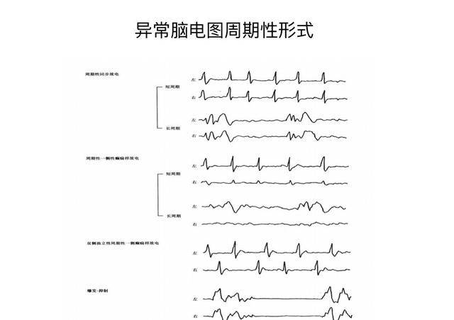 儿童脑电图基础与判读解析