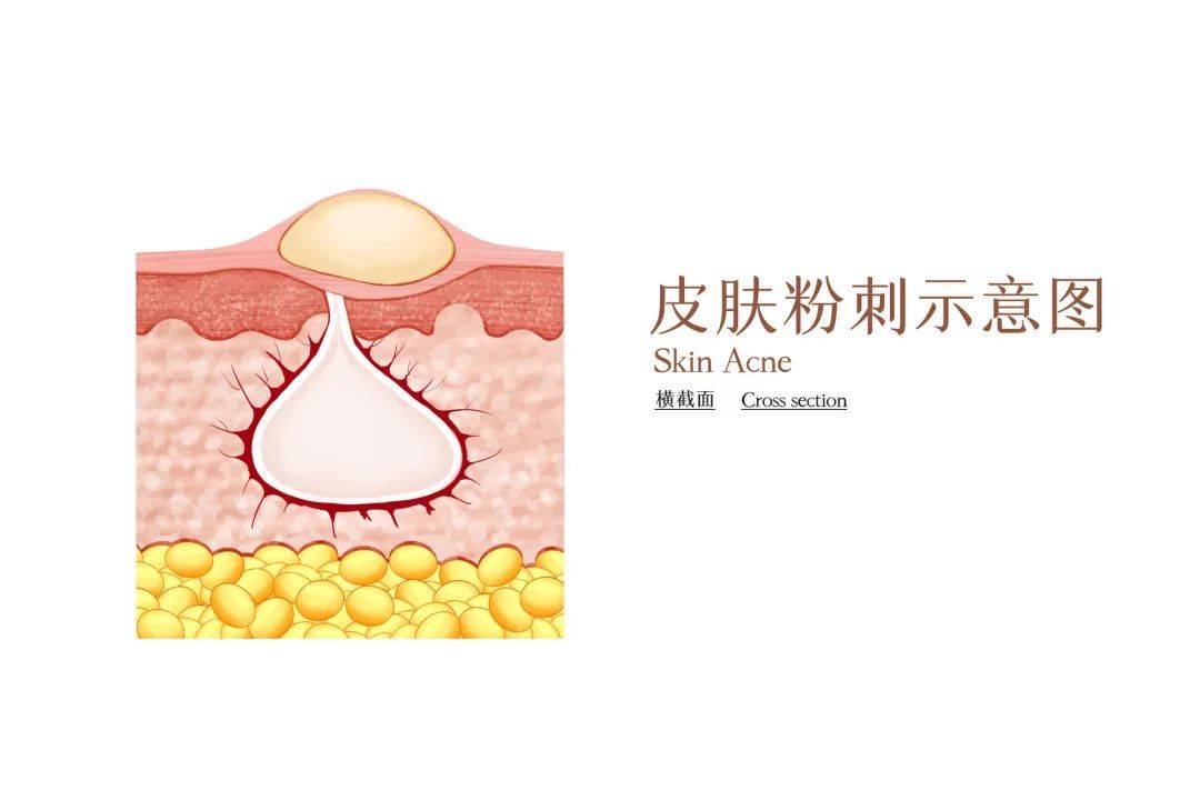 兰亭护肤代琦老师:脂肪粒,白头粉刺,毛周角化,还是分不清楚?