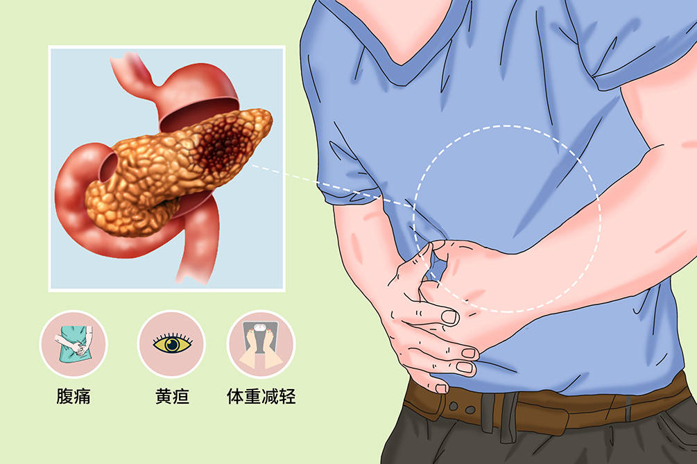 这4个异常是胰腺癌的警示灯!劝你别忽视——消化内科二病区