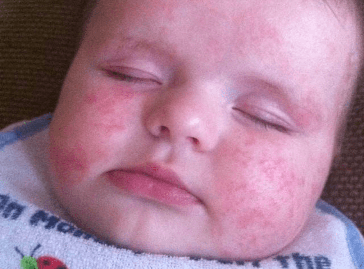 婴儿湿疹有三个主要诱因,作为父母,如何预防和护理婴儿湿疹？