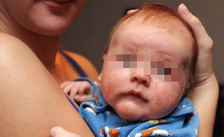 婴儿湿疹有三个主要诱因,作为父母,如何预防和护理婴儿湿疹？