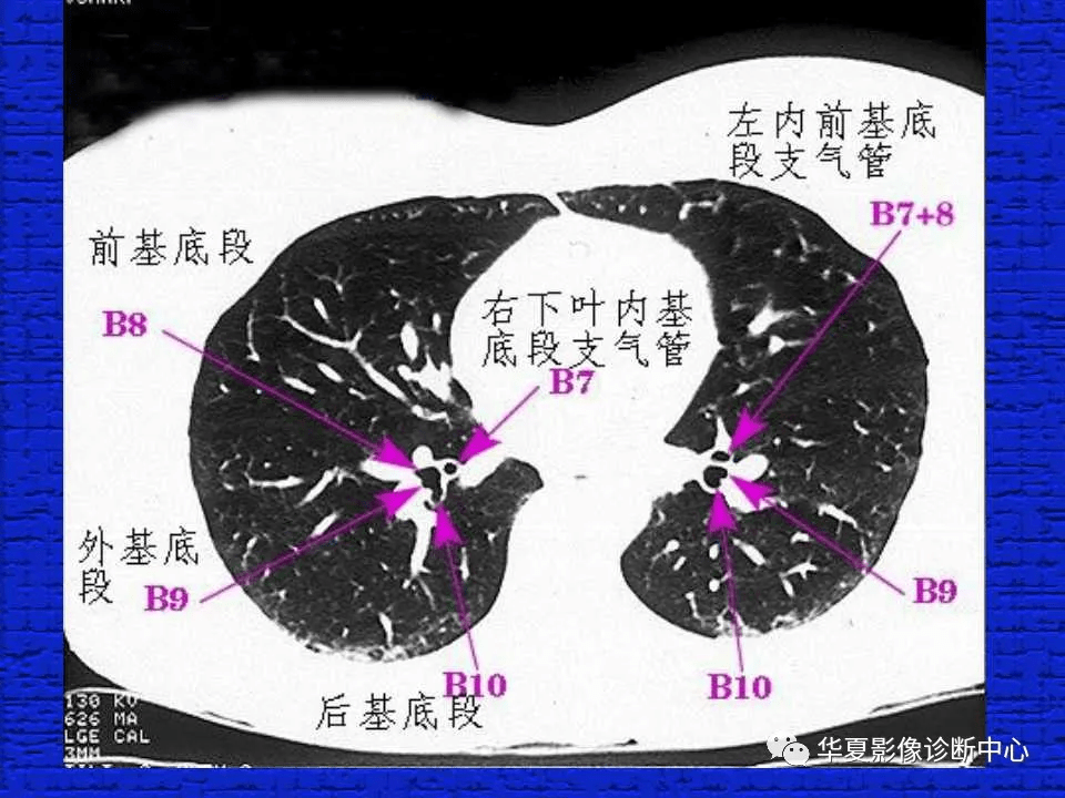 ct入门 | 结合解剖谈正常胸部ct读片