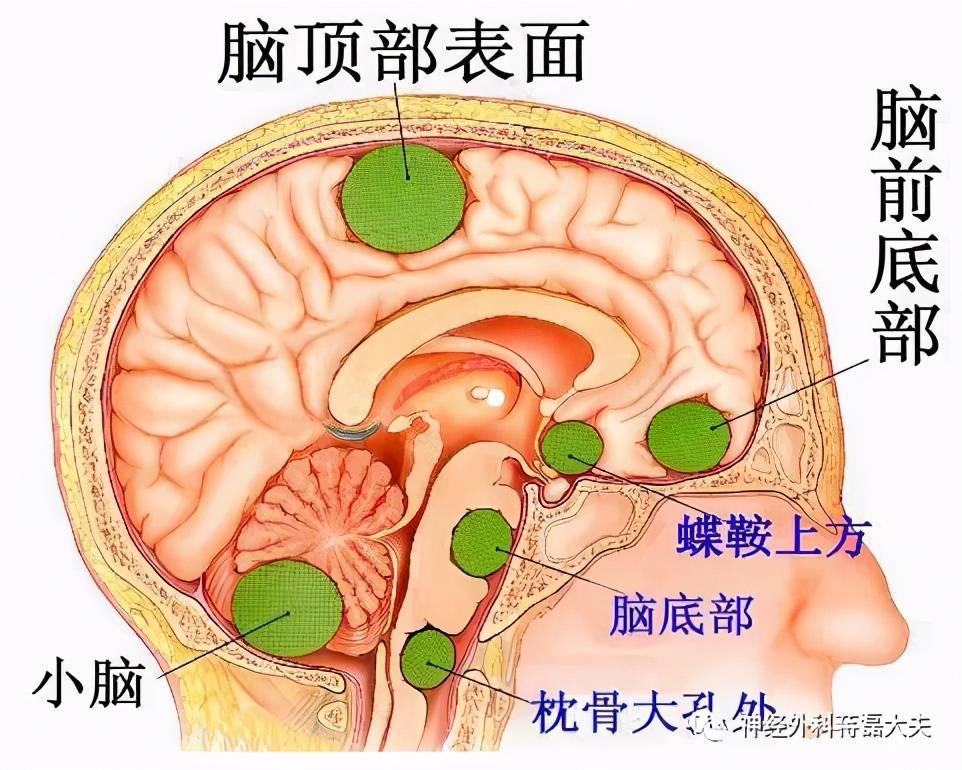 桥小脑角区(cpa)是一个锥形窄小的空间,集中了听神经,面神经,三叉