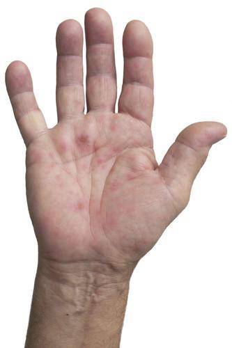 肝掌是慢性肝病常见的体表症状之一,在患者掌心大小的鱼际,指尖,掌面