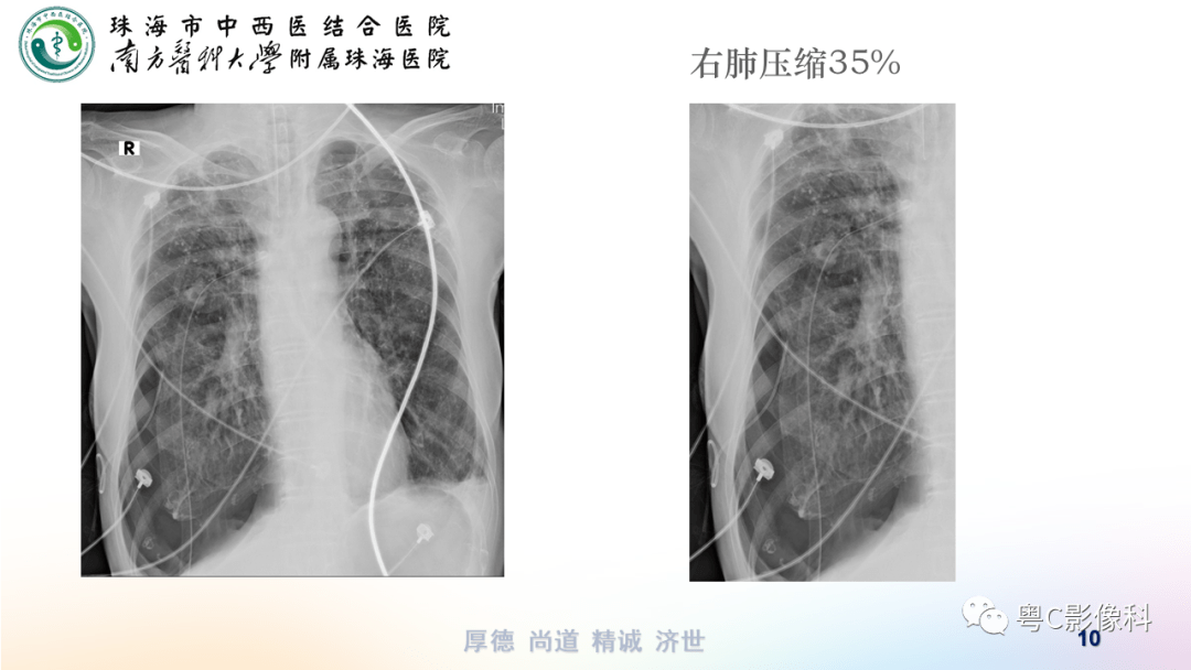 气胸,胸腔积液,肋骨骨折影像表现