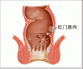 二,直肠癌