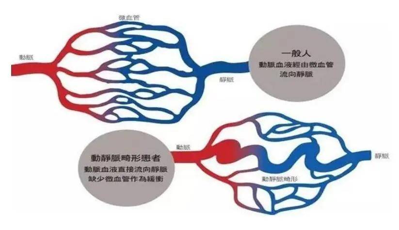 因为它,脑动静脉畸形变得不再可怕