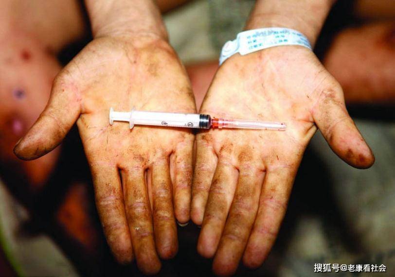 原创艾滋病容易伪装成皮肤病?别慌,一文教你识别它们的不同