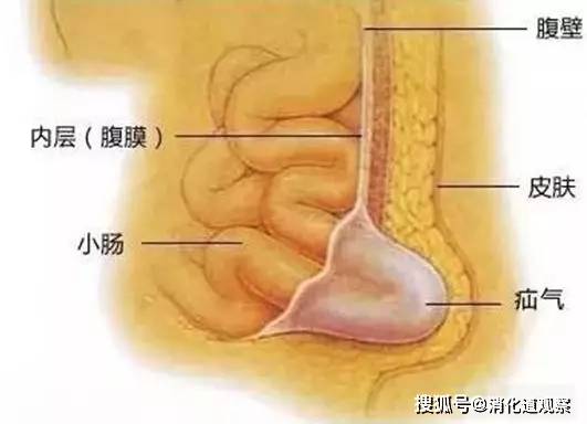 中老年患疝气是怎么回事?