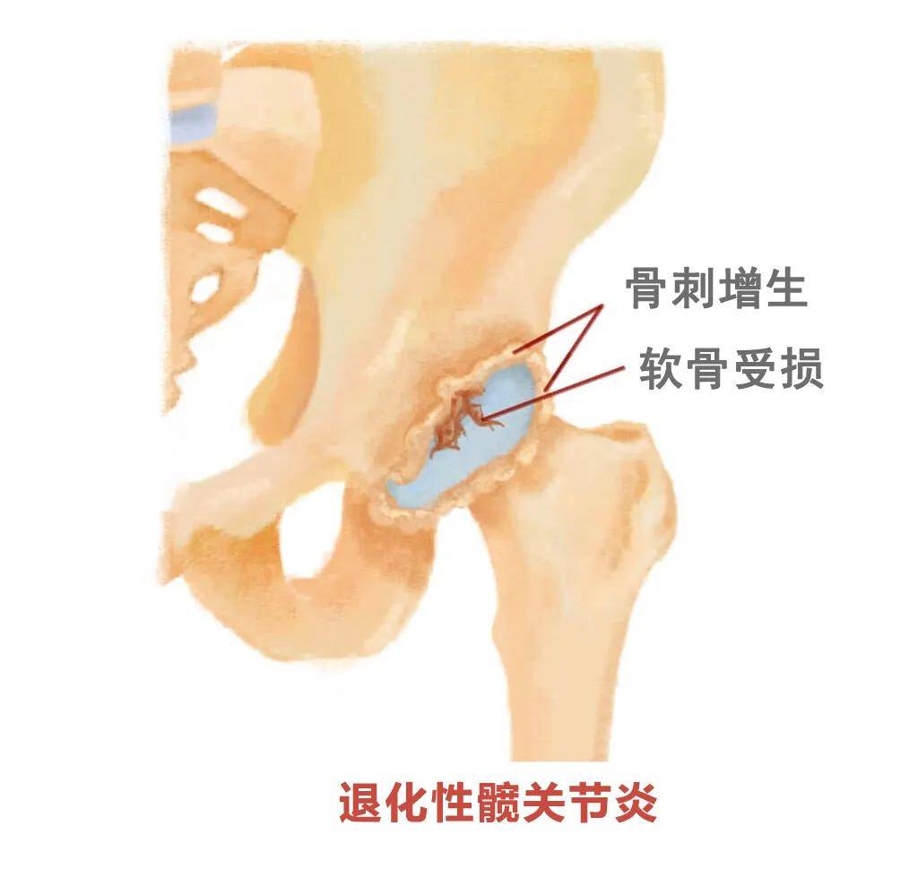 郴州骨科医院在线科普引起髋关节疼痛的常见疾病有哪些