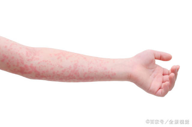 原创感染艾滋后出现的"红点"是什么呢?一般多久会出现?医生告诉您