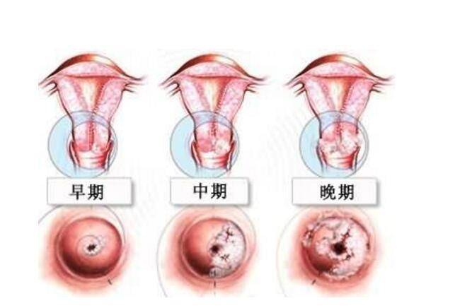 女人感染hpv不能吃虾?医生:真正不能吃的或是这3物