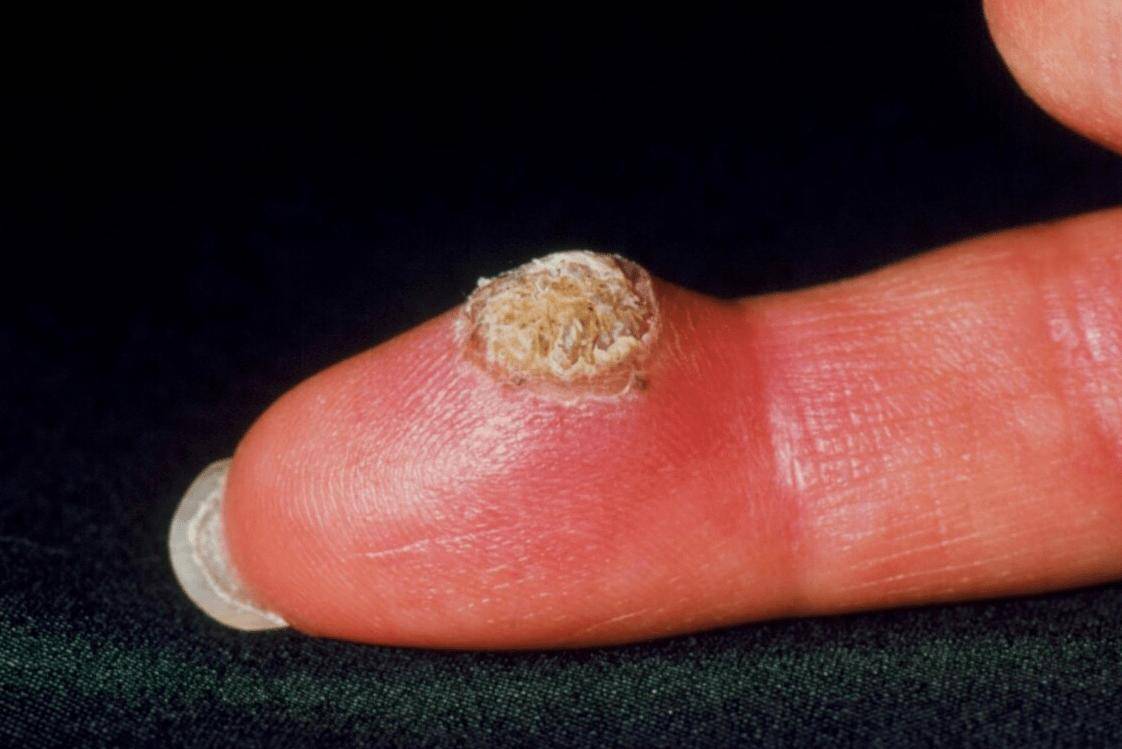 感染高危hpv的一个典型表现就是身上会长出疣体,如菜花疣,鸡冠疣等