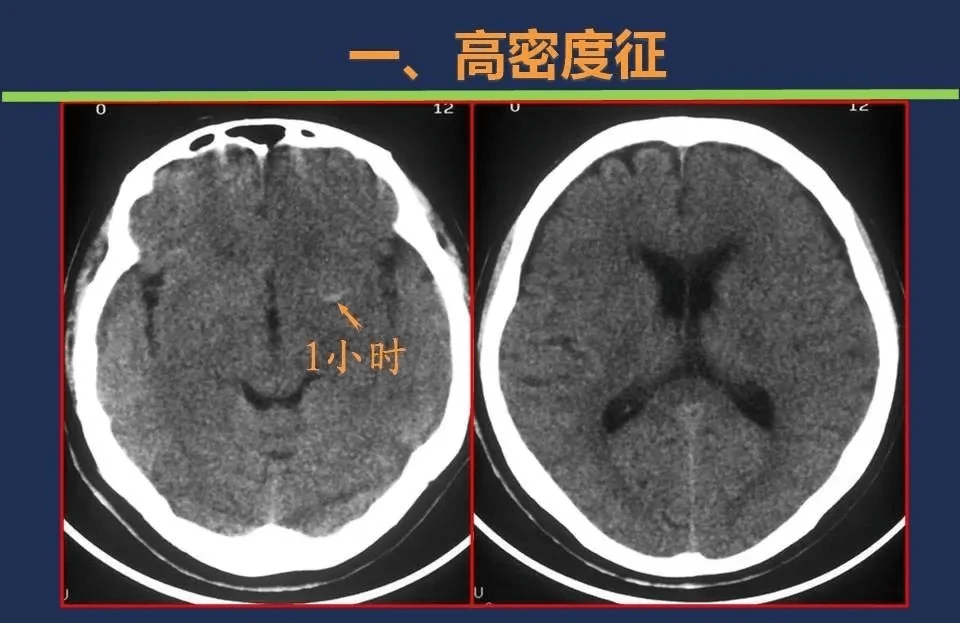 没有mri超早期如何利用ct诊断脑梗死