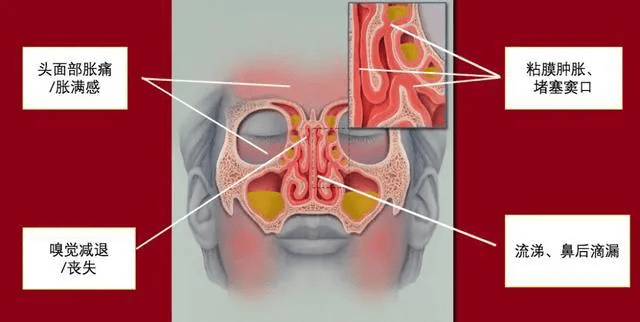 鼻窦炎更威胁身体健康