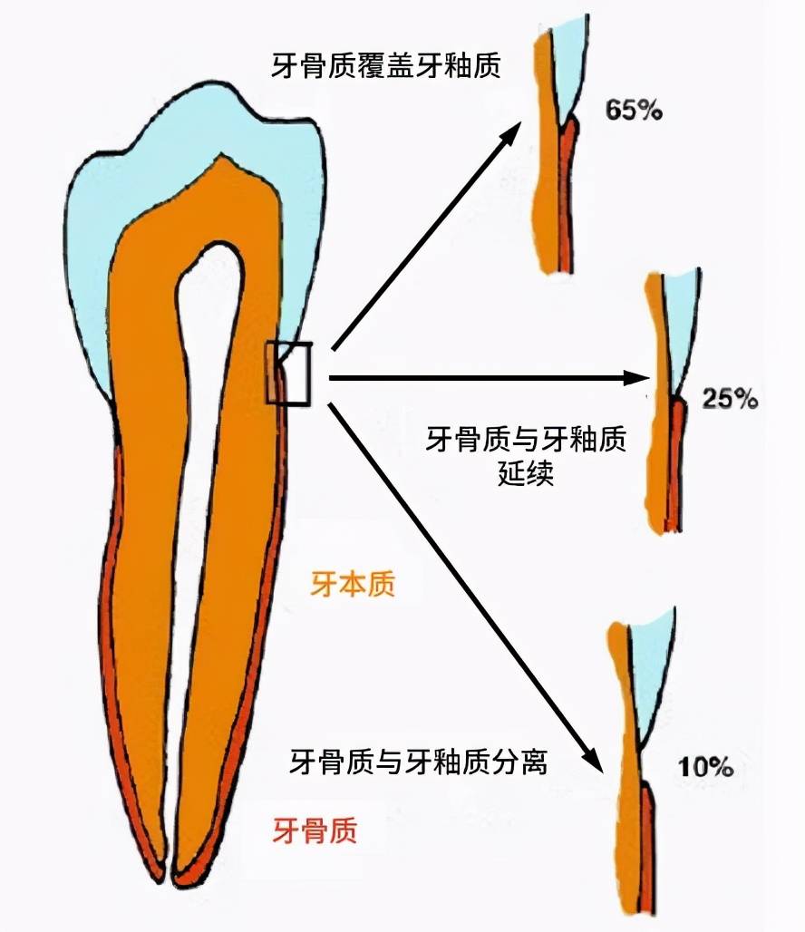 (3)牙釉质和牙骨质在此处产生了空隙.