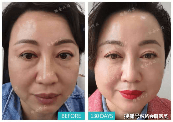 关于泪沟,眼袋手术,你是不是也有过这些心里话