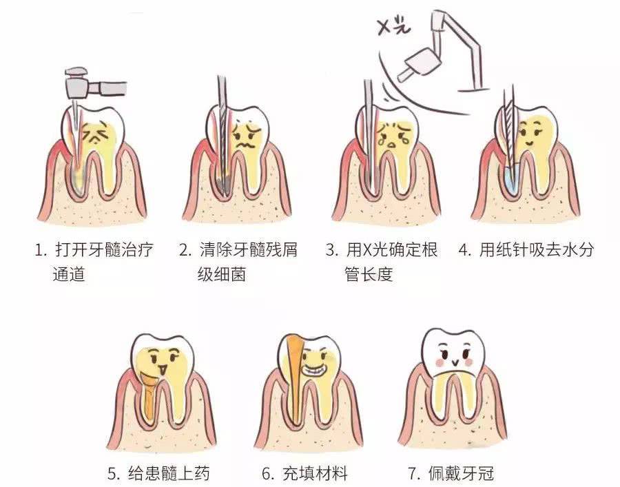 我得了牙髓炎,吃药能治好吗?