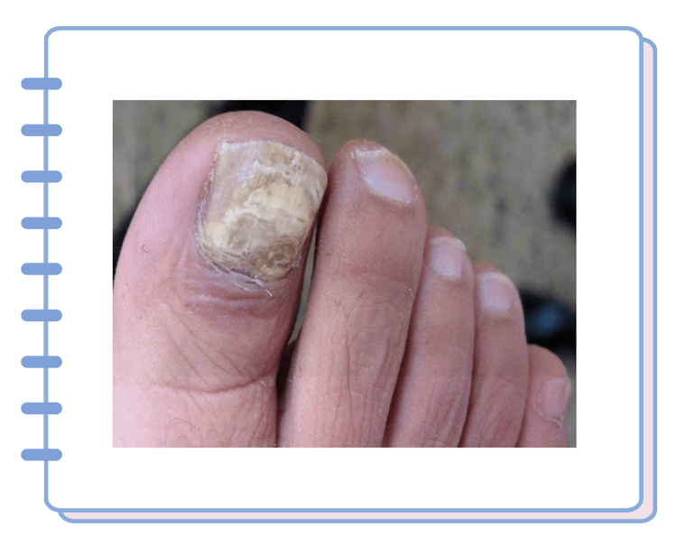 腐烂,分层此时真菌会跑到指甲下面从内部搞破坏另一种则是甲下真菌病