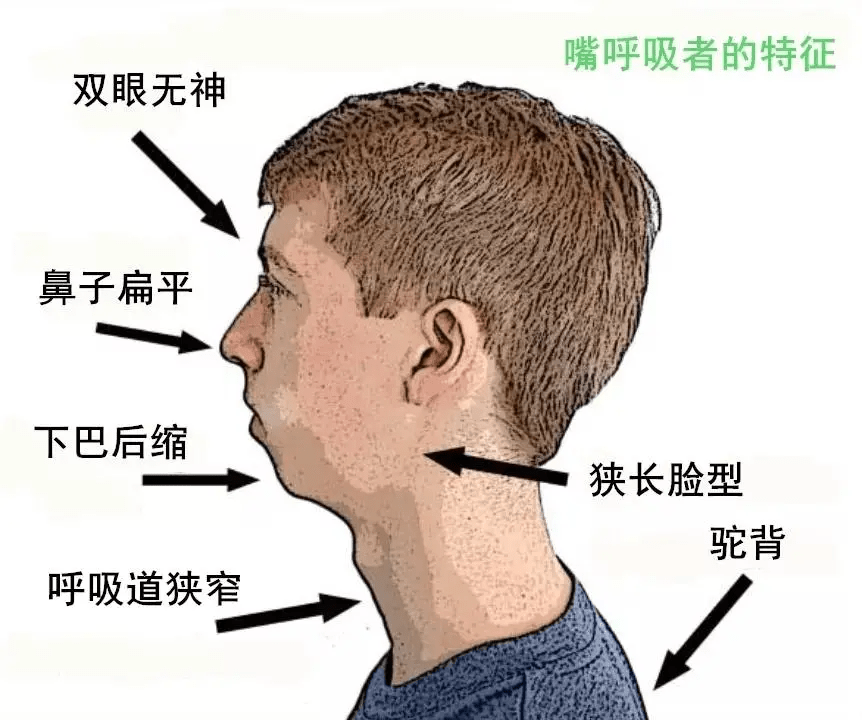 清鼻堂科普:口呼吸的危害你难以想象!除了变丑,还有这些影响!