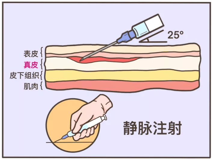 最痛:皮内注射 (代表:打青霉素前做的「皮试」)