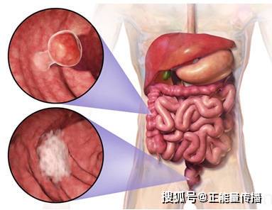 原创早期肠癌,不声不响?医生:上厕所时出现3种"怪象",尽早做肠镜检查