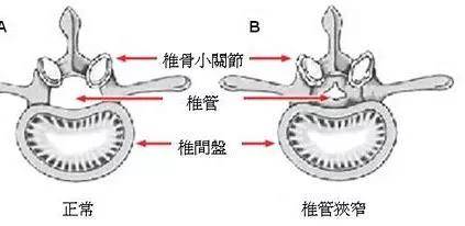 椎管狭窄,你的脊髓已不堪重负!
