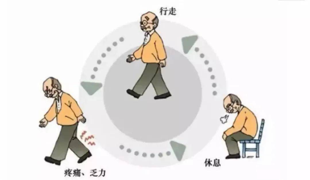 都知道"心梗","脑梗",但你听说过"腿梗"吗?