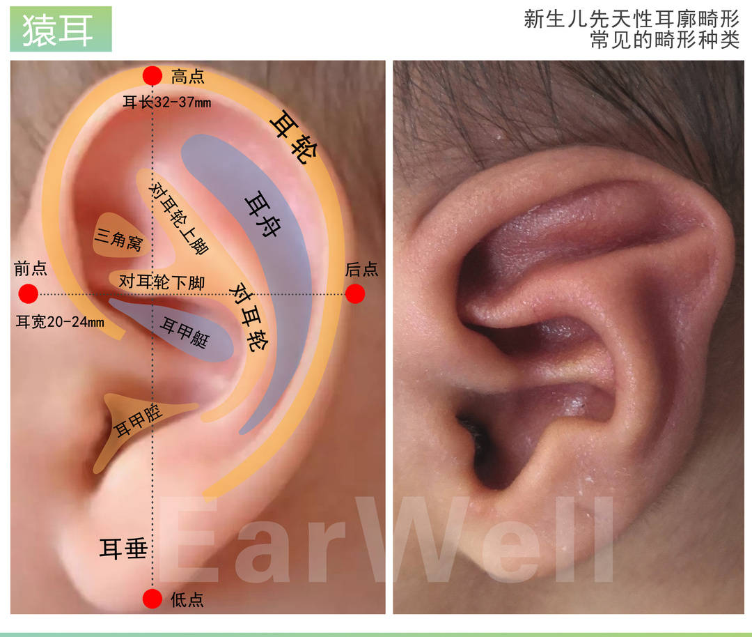 出现这些情况,请注意可能是耳畸形出没!