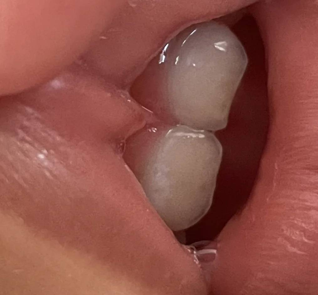 而针对轻度的白斑,且牙釉质没有缺损的情况下,可以多用含氟牙膏,或