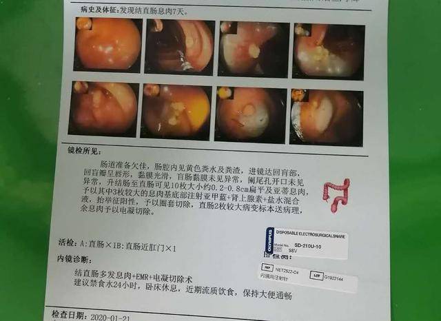 做了胃肠镜吓一跳:一家4口都有息肉,父亲长了13颗,将要癌变