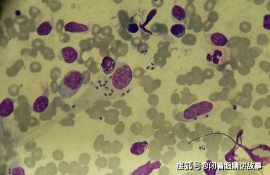 靠吃人肉为生的寄生虫,在美国蔓延,被感染者面部溃烂痛不欲生_利什曼