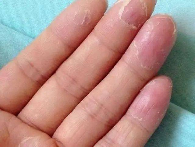 蒸汽手膜真不错 有了ksc蒸汽手膜干纹倒刺全绕道