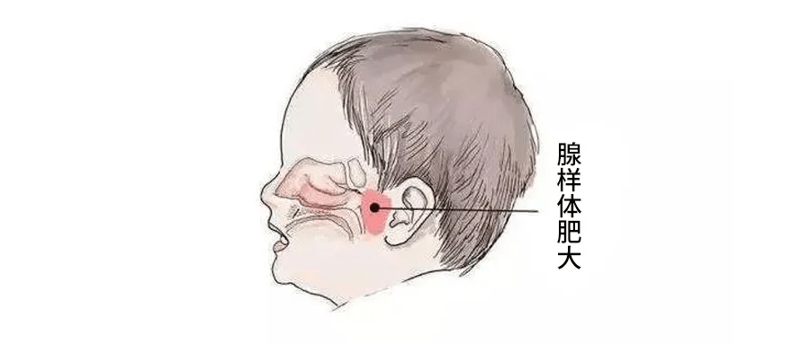 一般6岁时达高峰,如果过度增生引起相应的临床症状则为腺样体肥大