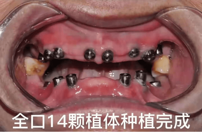 北京整牙:种植牙和烤瓷牙哪个不疼?