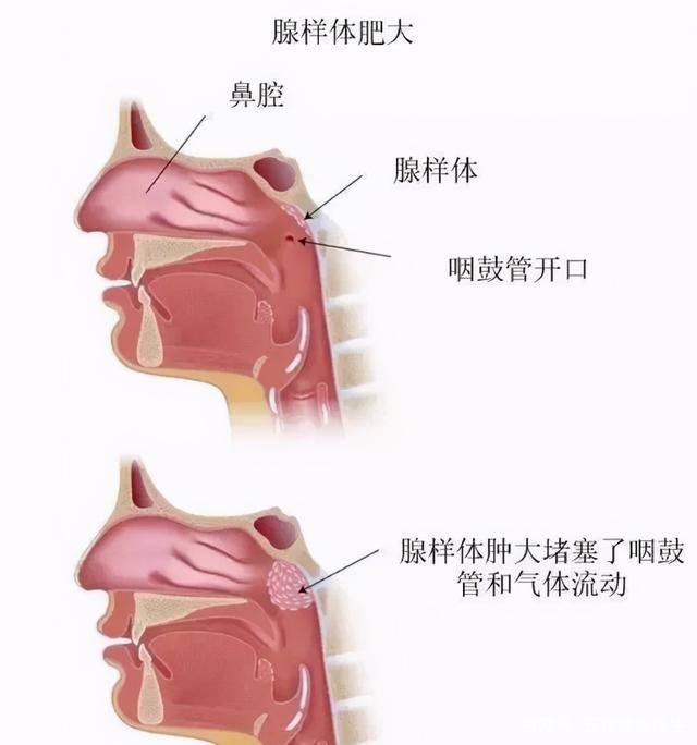 腺样体肥大可致"口呼吸"而引起腺样体面容.