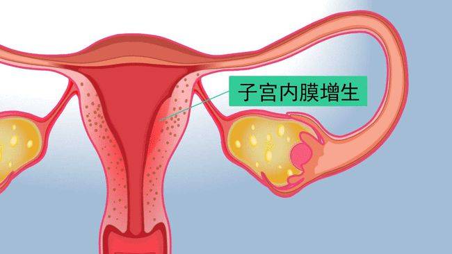 报告检查显示子宫内膜不匀是怎么回事宫茹清科普都有哪些原因