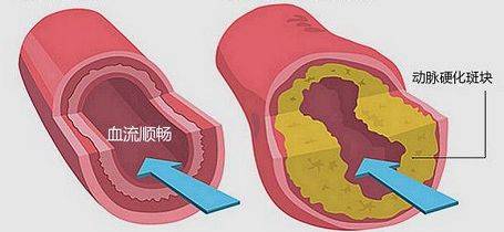 保护心血管,预防动脉硬化!3大类食物帮你补足维生素k