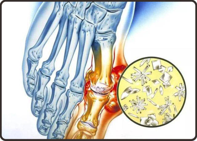 痛风疾病四大误区,正确认识才能治好!