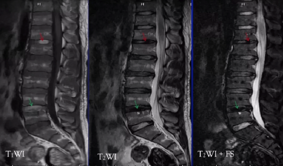 【通过上图可以看到t12/l1及l4/l5椎间盘在t1wi上为高信号,在压脂的